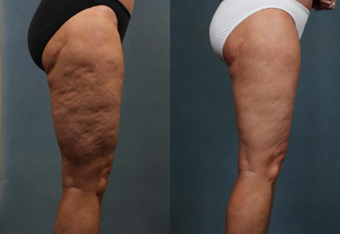 Cellulite Treatments Before & After Photos Patient 613 | Louisville, KY | CaloSpa® Rejuvenation Center